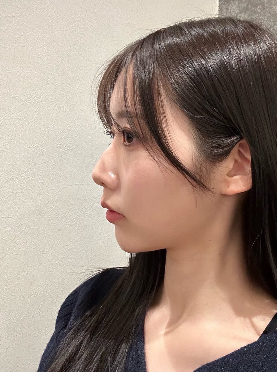 kollry_ryly's tweet photo. 顎ヒアルってマジで人生変わるからね‼️
賛否両論あるけど、製剤と先生ちゃんと選べば、たった数ccで横顔の完成度めちゃくちゃ上がる https://t.co/VLeBCPA3Hb