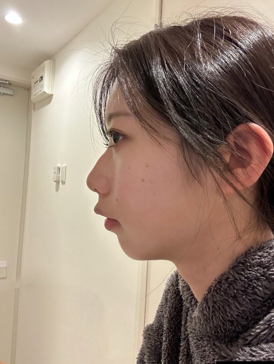 kollry_ryly's tweet photo. 顎ヒアルってマジで人生変わるからね‼️
賛否両論あるけど、製剤と先生ちゃんと選べば、たった数ccで横顔の完成度めちゃくちゃ上がる https://t.co/VLeBCPA3Hb