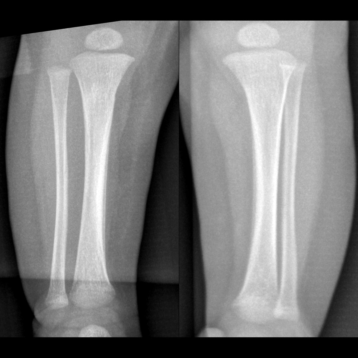 pedsimaging's tweet photo. Infant being worked up for suspected child abuse
AP radiographs show bilateral symmetrical periosteal reaction along medial diaphyses of tibiae
#FOAMed #MedEd #FOAMRad #PedsRad #RadEd #radiology #pediatrics #radiologia #Ortho #Orthopedics #OrthoTwitter #paediatrics https://t.co/HJnSWSkNgB