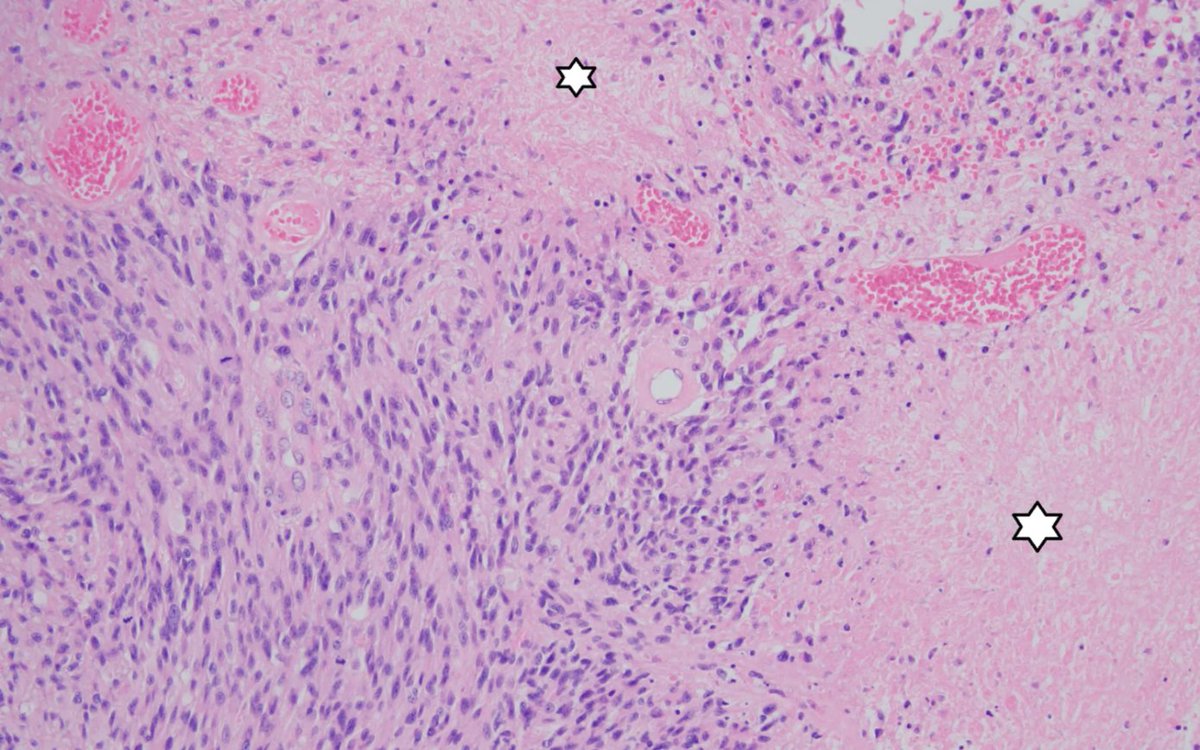 jppathpd's tweet photo. Dx? brain BRAF V600E #Pathkeys https://t.co/17PGF4JYvW