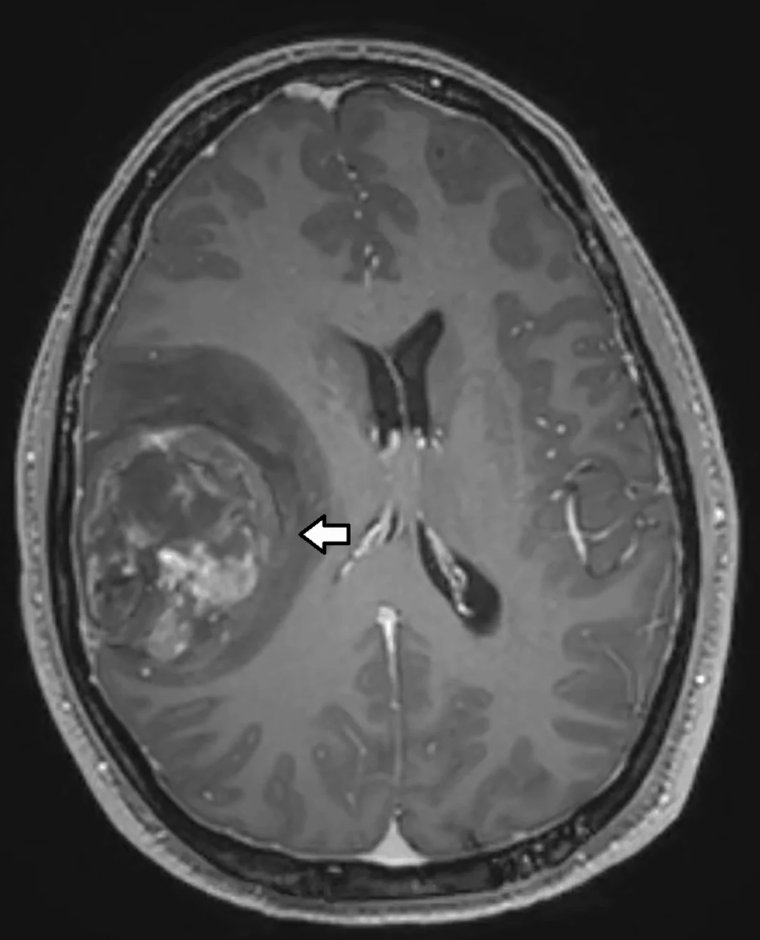 jppathpd's tweet photo. Dx? brain BRAF V600E #Pathkeys https://t.co/17PGF4JYvW