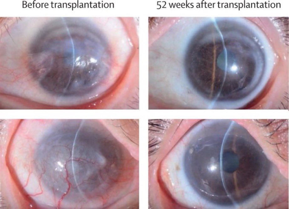 SciNatureNews's tweet photo. 🚨: Scientists performed worlds first stem cell transplant successfully restoring vision in blind patients, opening a new era in treatments to cure blindness. https://t.co/IwaCvNoXEE