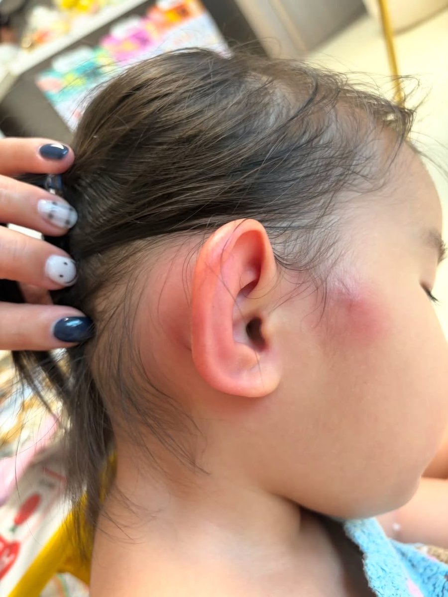 With_love_susan's tweet photo. My baby came home from daycare with so many mosquito bites. Can mosquito bites really cause this much swelling and irritation? Could my baby be having an allergic reaction to mosquito bites? https://t.co/Vd4oQkFAhC