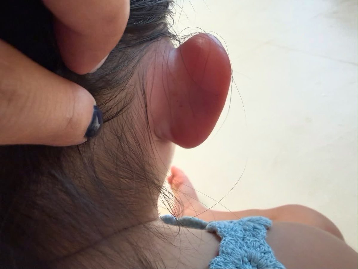 With_love_susan's tweet photo. My baby came home from daycare with so many mosquito bites. Can mosquito bites really cause this much swelling and irritation? Could my baby be having an allergic reaction to mosquito bites? https://t.co/Vd4oQkFAhC
