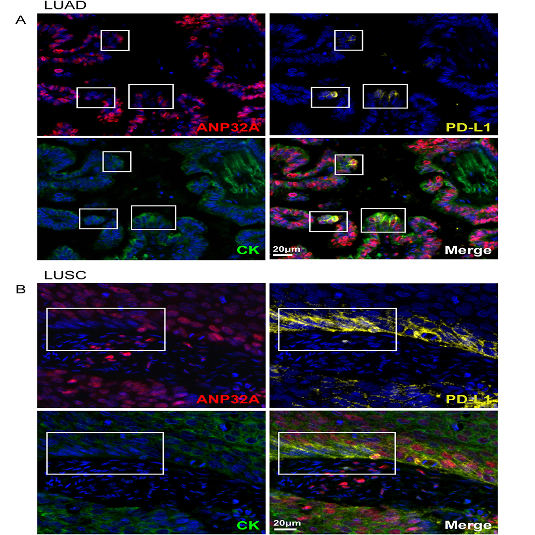 GenesNDiseases's tweet photo. Why do some #LungCancers resist PD-1/PD-L1 #immunotherapy?
This study identifies ANP32A as a regulator of #PDL1, showing that its loss enhances EP300/CREBBP activity & may influence treatment response. @FudanUniversity
#GenesAndDiseases: https://t.co/csteXmyw94 https://t.co/kELGWHgLXO