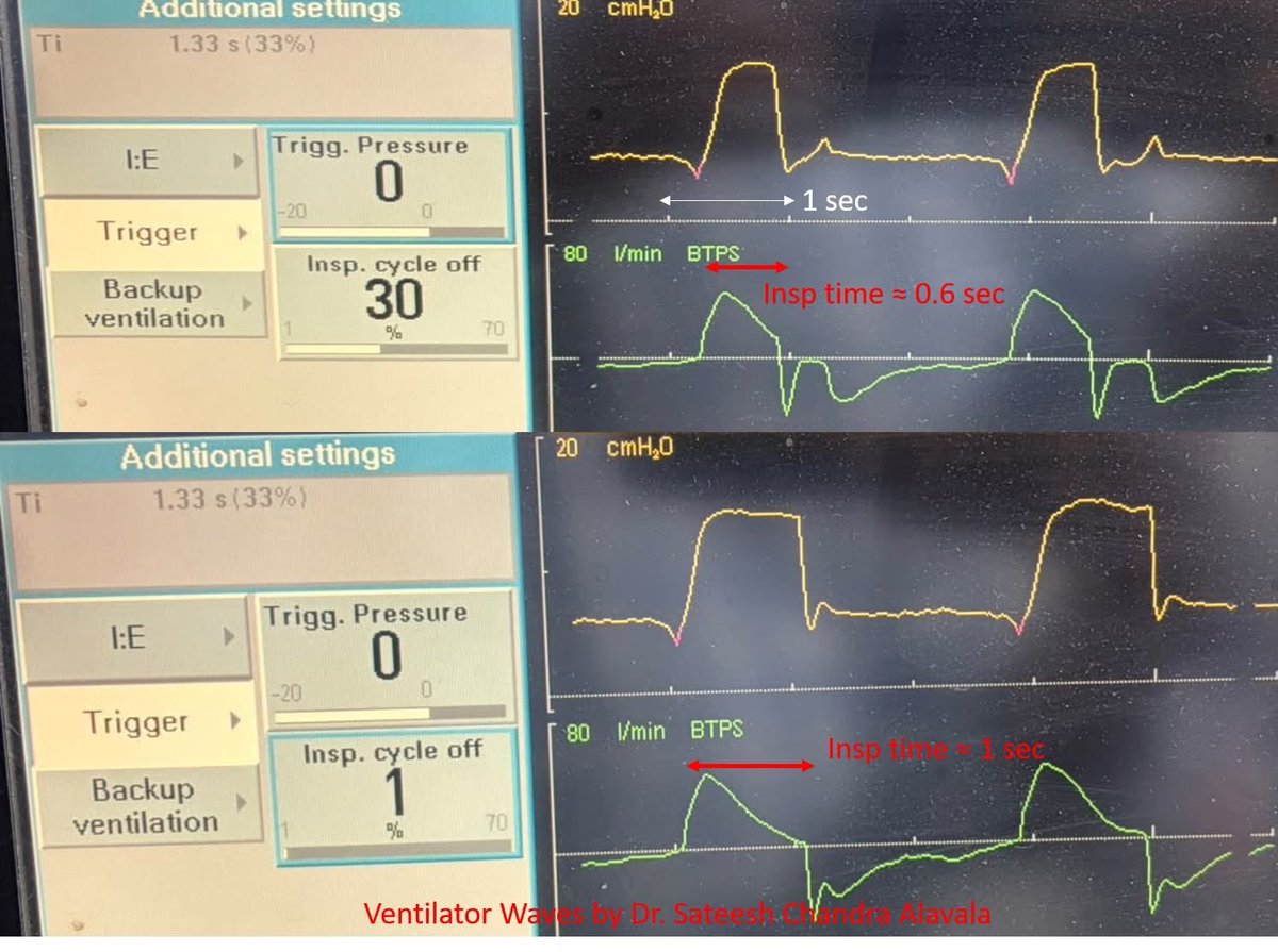 DrSateeshPCCM's tweet photo. Early Cycling

The flow time scalar shows an upward deflection during the initial phase of expiration in a patient-triggered breath. This occurs because neural inspiration continues even after the end of mechanical inflation, a phenomenon known as early cycling. https://t.co/CebfKtq03A
