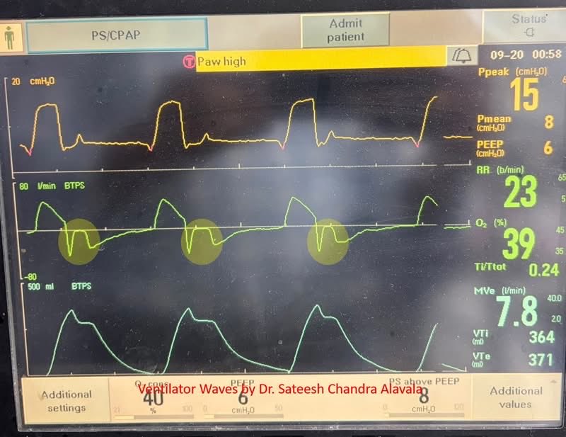 DrSateeshPCCM's tweet photo. Early Cycling

The flow time scalar shows an upward deflection during the initial phase of expiration in a patient-triggered breath. This occurs because neural inspiration continues even after the end of mechanical inflation, a phenomenon known as early cycling. https://t.co/CebfKtq03A