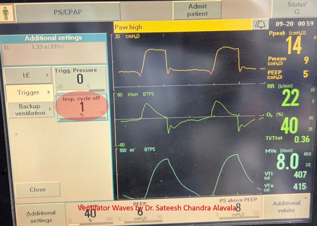 DrSateeshPCCM's tweet photo. Early Cycling

The flow time scalar shows an upward deflection during the initial phase of expiration in a patient-triggered breath. This occurs because neural inspiration continues even after the end of mechanical inflation, a phenomenon known as early cycling. https://t.co/CebfKtq03A