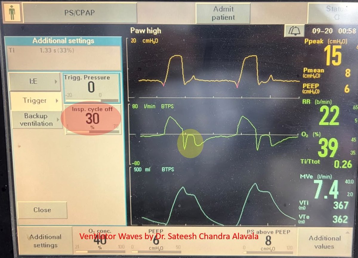 DrSateeshPCCM's tweet photo. Early Cycling

The flow time scalar shows an upward deflection during the initial phase of expiration in a patient-triggered breath. This occurs because neural inspiration continues even after the end of mechanical inflation, a phenomenon known as early cycling. https://t.co/CebfKtq03A
