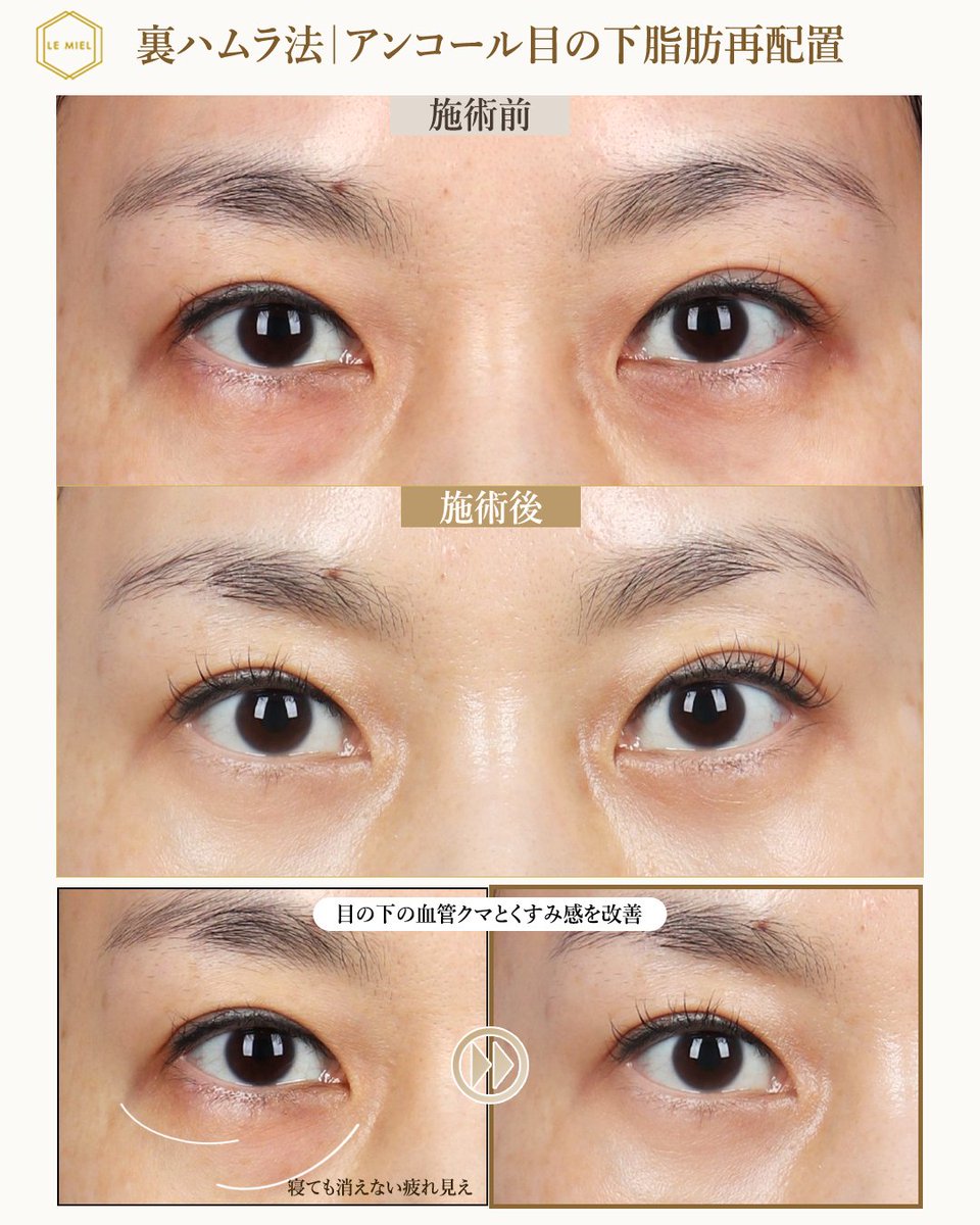 lemielps's tweet photo. 目の下脂肪再配置・クマ取りを検討中の方、ぜひ参考にしてください👀
ルミエルの目の下脂肪再配置 症例まとめ。

脂肪をただ取るのではなく、目の下の状態を見ながら整え、必要な部分は再配置。

今の目元を見て「何が必要か？」から一緒に考える、
女性院長による写真診断から始めてみてください👩‍⚕️ https://t.co/zEqoos3QHQ