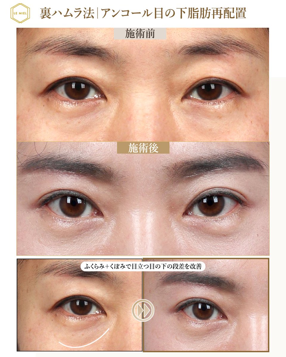 lemielps's tweet photo. 目の下脂肪再配置・クマ取りを検討中の方、ぜひ参考にしてください👀
ルミエルの目の下脂肪再配置 症例まとめ。

脂肪をただ取るのではなく、目の下の状態を見ながら整え、必要な部分は再配置。

今の目元を見て「何が必要か？」から一緒に考える、
女性院長による写真診断から始めてみてください👩‍⚕️ https://t.co/zEqoos3QHQ