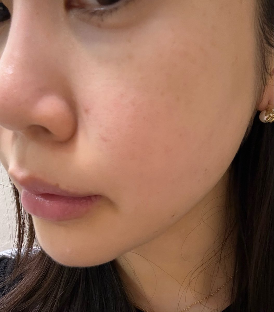 美容垢っぽいの作った❣️
この前友達とハンズ行ってスキンケア系いっぱい買ってきた✌️
Xで見てからずっと気になってたキュレルのパウダーバーム良い🙆‍♀️
顔脱毛前だからすっぴんで来てるんだけどこれ塗ってるからまじでテカらない‼️
👉朝塗って夕方の状態だけど皮脂全然出てない🥹 https://t.co/rXQV1EzbXi