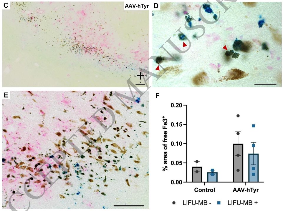 ScienceofPD's tweet photo. Researchers report early, non-invasive "Low-intensity focused ultrasound combined with microbubbles" intervention can counteract mechanisms linked to excessive neuromelanin accumulation in a non-human primate model that overexpresses human tyrosinase
https://t.co/6kuB5myANS https://t.co/BA42sIK673