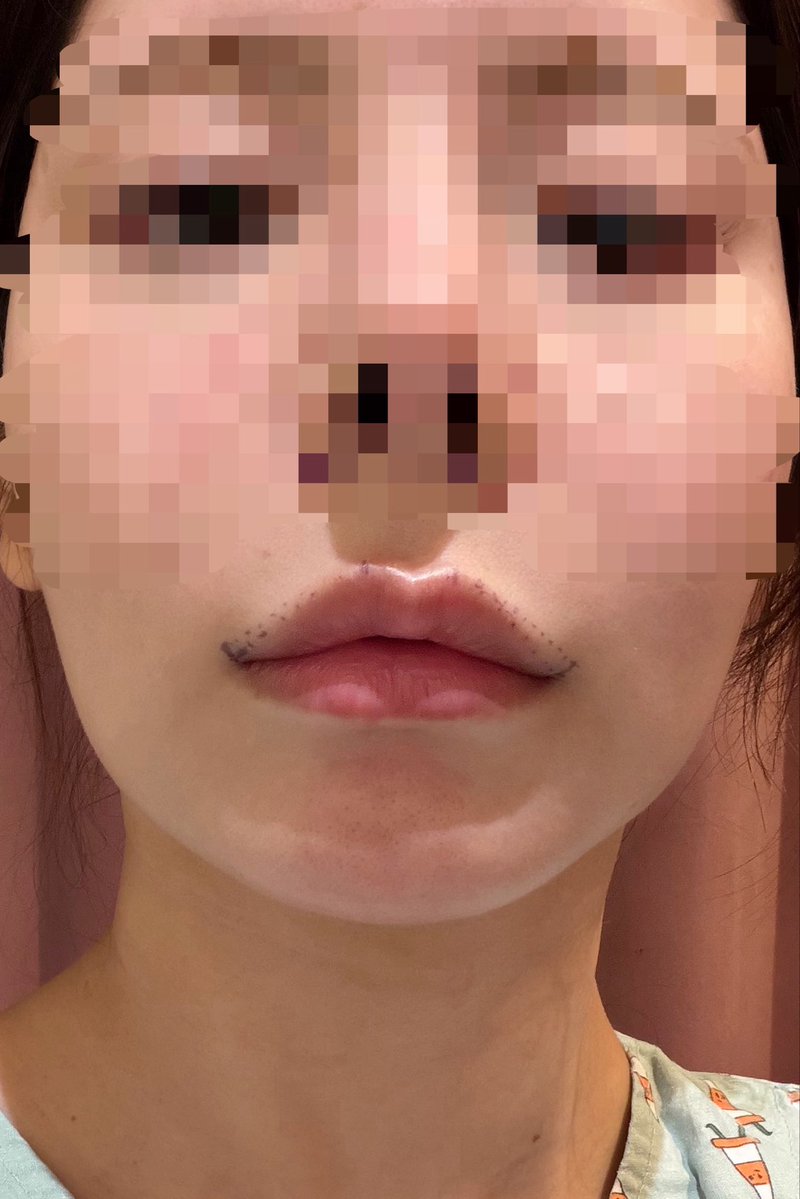 今から外側人中!手術頑張ってきます👄✨
サナギから蝶になれますように…!() https://t.co/m3FwfTYliF