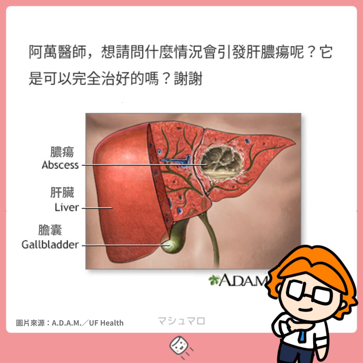 drlifesucks's tweet photo. 🦠 什麼是肝膿瘍(liver abscess)呢？
簡單來說，就是細菌跑進肝臟裡，
造成感染並且形成一包膿。
少數也可能由阿米巴原蟲感染引起～

🔍 感染從哪裡來呢？
1️⃣ 膽道感染直接蔓延到肝臟
2️⃣ 腹腔內的感染經由肝門靜脈傳到肝臟
3️⃣ 其他部位的細菌經由血液循環，被帶到肝臟
在台灣「克雷伯氏肺炎菌（又稱 KP 菌）」造成的肝膿瘍尤其常見～

👥 哪些族群要多加留意呢？
糖尿病、癌症、免疫力低下，以及本身有肝膽胰疾病等族群，發生肝膿瘍的風險比較高。

💊 肝膿瘍能治好嗎？
細菌性肝膿瘍通常需要接受數週的適當抗生素治療，必要時再透過引流，將膿液排出。經過適當治療，大部分患者可以治癒。

⚠️ 肝膿瘍可不能小看喔
嚴重時可能造成敗血症，甚至危及生命，因此通常需要住院治療與後續追蹤。

Ref: 1. PMID: 18826824 2. PMID: 25442876