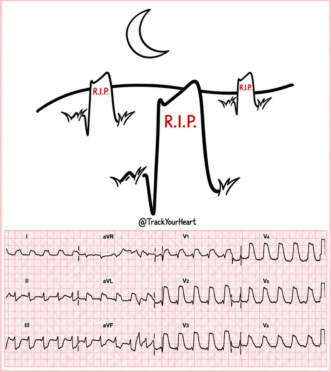 TrackYourHeart's tweet photo. ECG From Scratch #47: Why ST 
Elevation Isn’t Always STEMI

You see ST elevation. The instinct is immediate: STEMI.

But ST elevation is an #ECG finding, not a diagnosis.

The challenge is recognizing acute coronary occlusion quickly without mistaking its mimics for it.
A  🧵🧵🧵 https://t.co/ztLaRVu4QB
