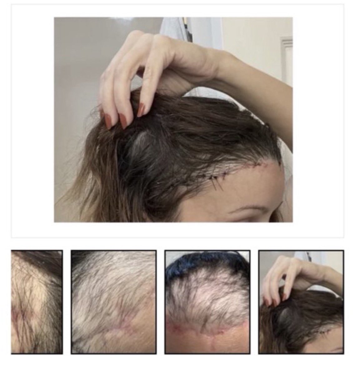 wan_hello_'s tweet photo. 額縮小の薄毛・脱毛リスクは男性だけの問題じゃなく、女性も全く同じ。過剰に皮膚を引き伸ばすと血流が途絶えて毛根が死にます。

「血流を守る安全圏の中で、適量を見極められるドクターかどうか」これが手術の成否を分ける境界線です。 https://t.co/nqf23lbHyT