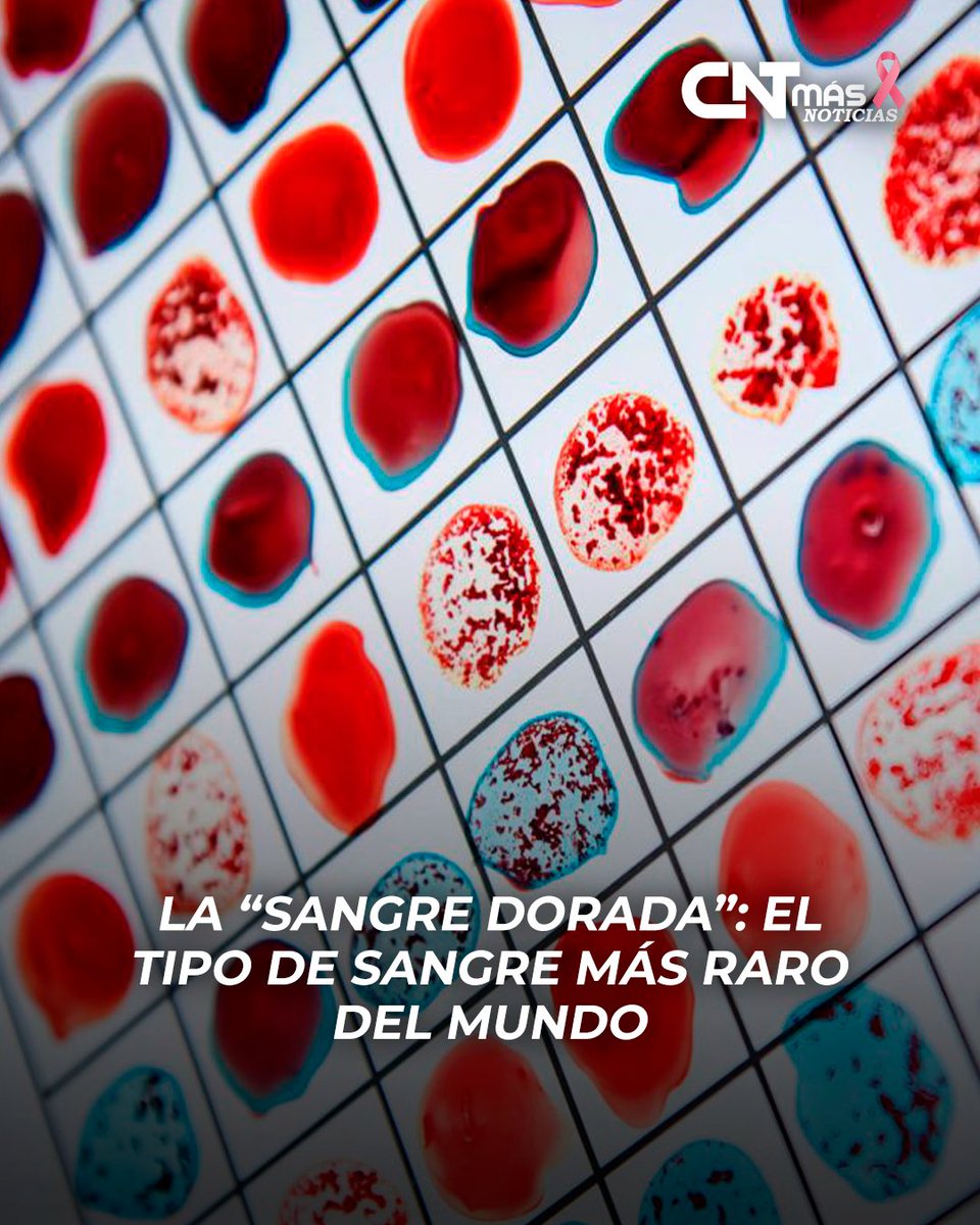 CntMas87719's tweet photo. El llamado Rh-null es uno de los fenotipos sanguíneos más raros conocidos. Sus glóbulos rojos carecen de todos los antígenos del sistema Rh, lo que le otorga un enorme valor para la medicina transfusional.
#SangreDorada #RhNull #Ciencia #Medicina #Salud #Curiosidades #CNTMAS https://t.co/mPji04XErF