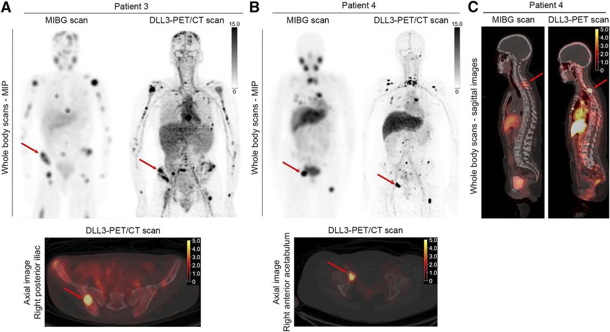 JournalofNucMed's tweet photo. DLL3 represents a clinically accessible therapeutic target in neuroblastoma, and DLL3-directed PET imaging may enable noninvasive identification of patients suitable for DLL3-targeted therapies. Read more: https://t.co/46woyaAmYO

#NuclearMedicine @LewisLabMSKCC https://t.co/UwZYZMCoJz