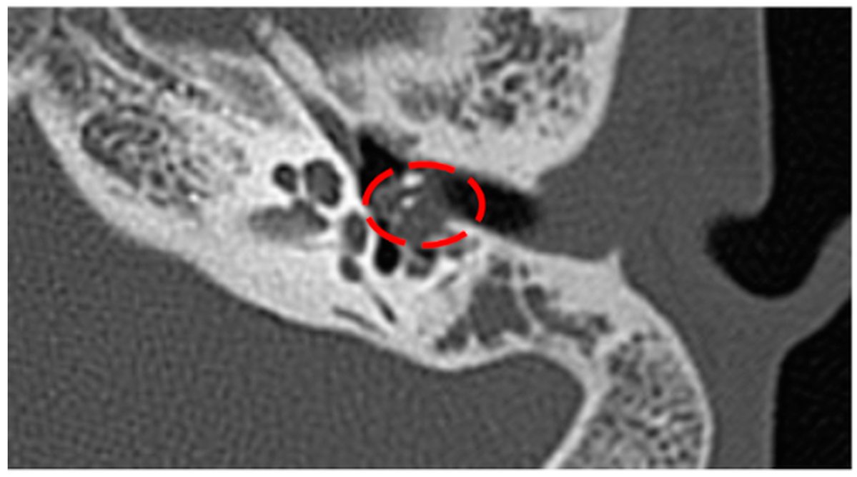 Germs_MDPI's tweet photo. 🦠 Extensively Drug-Resistant #Acinetobacterbaumannii in #ChronicOtomastoiditis: #Endoscopic Source Control and Adjunctive Topical Colistin Under Constrained Access to Last-Line Medicines in the European Union—A Romanian Case Report

📖Read here:  https://t.co/70MSR7ksFp https://t.co/I2knmDmmjY