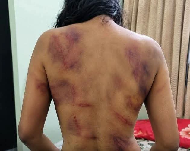 Rockumon's tweet photo. Another young woman, another dowry torture case from Kerala.
Anju, just 24, is fighting for her life in Kollam District General Hospital after
suffering brutal assaults—both abroad and back home because her dowry was “not enough.” https://t.co/eW9Hh6ML5F