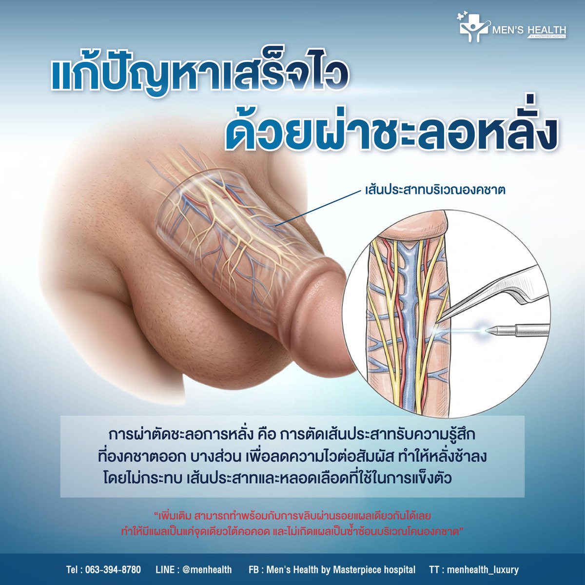 MH_MTP's tweet photo. "แก้ปัญหาเสร็จไว... ชะลอการห��ั่งแบบถาวร?"
ผ่าตัดชะลอหลั่ง คืออะไรแล้วทำยังไง?
เป็นการผ่าตัดเล็กเพื่อ ตัดเส้นประสาทรับความรู้สึกออกบางส่วน ช่วยลดความไวต่อสัมผัส ทำให้หลั่งช้าลงอย่างถาวรครับ
.
#menhealthbymasterpiece #โรงพยาบาลมาสเตอร์พีช #หลั่งไว #ฉีดชะลอการหลั่ง #ผ่าชะลอการหลั่ง https://t.co/sDJbaVA5tk