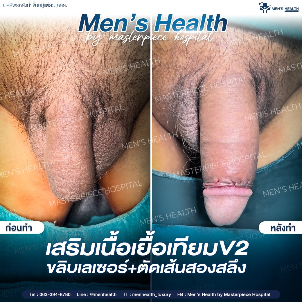 MH_MTP's tweet photo. เสริมขนาดด้วยเนื้อเยื้อเทียมV2
ขลิบเลเซอร์
ตัดเส้นสองสลึง
#menhealthbymasterpiece #โรงพยาบาลมาสเตอร์พีช https://t.co/39IfV6DsNL