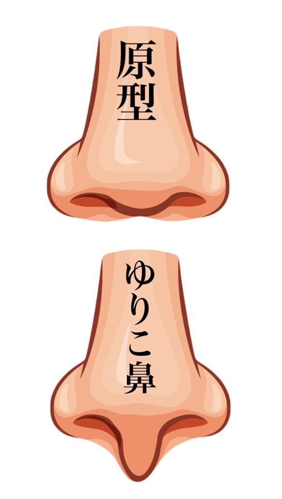 3b2zg's tweet photo. 原型の団子鼻から整形したらどうなるかのシュミレーション。

鼻尖縮小すると変化を感じられなくて、小鼻縮小するともっと団子鼻に見えて、鼻中隔延長するとACR三角形になって、ゆりこ鼻するとチンチンの鼻柱になる。

鼻柱下降術は忘れ鼻でもないでもないね。 https://t.co/lOPmPjjmVG