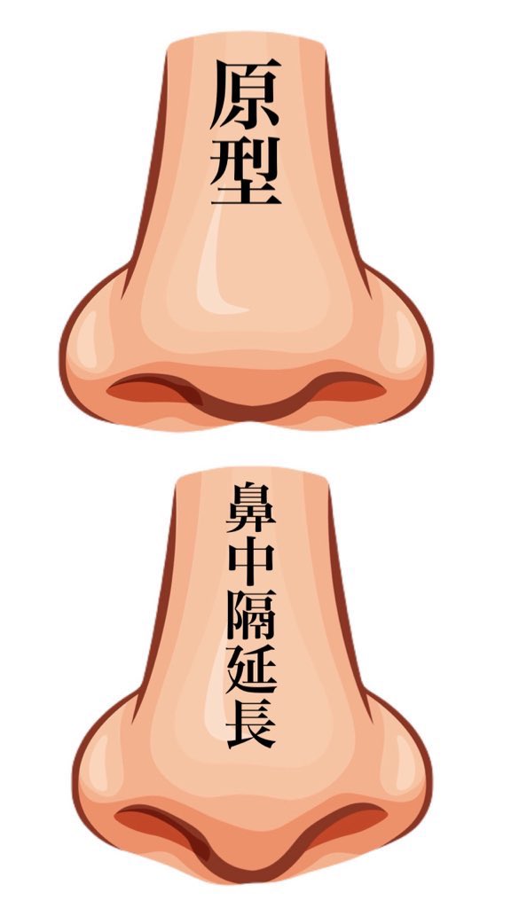 3b2zg's tweet photo. 原型の団子鼻から整形したらどうなるかのシュミレーション。

鼻尖縮小すると変化を感じられなくて、小鼻縮小するともっと団子鼻に見えて、鼻中隔延長するとACR三角形になって、ゆりこ鼻するとチンチンの鼻柱になる。

鼻柱下降術は忘れ鼻でもないでもないね。 https://t.co/lOPmPjjmVG