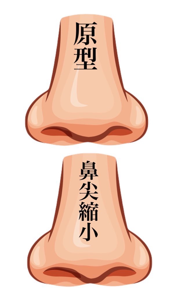 3b2zg's tweet photo. 原型の団子鼻から整形したらどうなるかのシュミレーション。

鼻尖縮小すると変化を感じられなくて、小鼻縮小するともっと団子鼻に見えて、鼻中隔延長するとACR三角形になって、ゆりこ鼻するとチンチンの鼻柱になる。

鼻柱下降術は忘れ鼻でもないでもないね。 https://t.co/lOPmPjjmVG