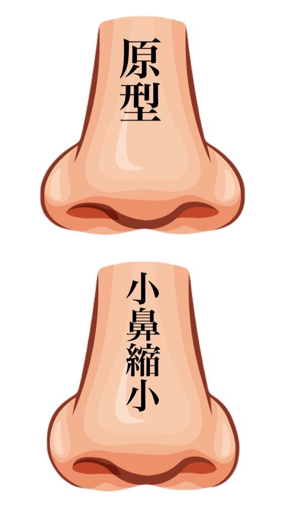 3b2zg's tweet photo. 原型の団子鼻から整形したらどうなるかのシュミレーション。

鼻尖縮小すると変化を感じられなくて、小鼻縮小するともっと団子鼻に見えて、鼻中隔延長するとACR三角形になって、ゆりこ鼻するとチンチンの鼻柱になる。

鼻柱下降術は忘れ鼻でもないでもないね。 https://t.co/lOPmPjjmVG