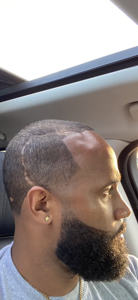 ChefAnthonyDC's tweet photo. 20 years ago TODAY, George Washington Hospital saved my life.

October 5th, 2006, I was diagnosed with an Arteriovenous Malformation, a rare brain abnormality causing me issues like severe headache and migraines. GW opened my head, went in, and fought for me. Twenty years later though… Not one headache. Not one seizure. Not one migraine. 

When God is in it, there is NO LIMIT.