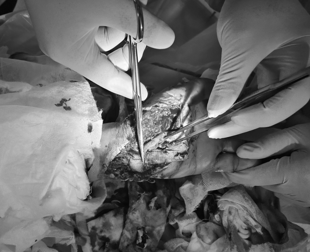 EverleighTid's tweet photo. [El médico usó una enzima especial para procesar el hueso durante la operación, luego descartó el residuo]， https://t.co/dm1imSWwFI