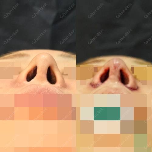 コーヘンから施術直後の写真もらったんだけど(仕事早過ぎ)私のオーダー通りでほんまにやばい😭
3回目の鼻整形で難易度高いのにカウセの時にお願いした通りになってる。気になってた鼻の穴が目立たなくなったしACRのバランスも土手再建もうま過ぎる…

アップノーズ改善
鼻孔縁下降
土手再建 https://t.co/MhUOwx6pvl