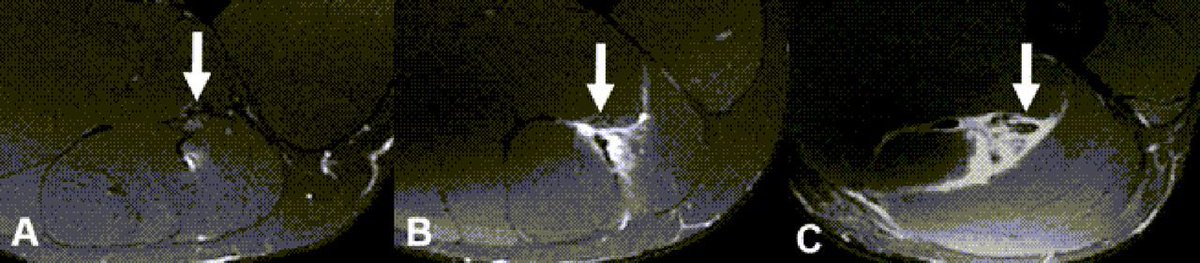 BJSM_BMJ's tweet photo. β οΈ Sciatic nerve involvement is associated with longer return to sport in collegiate American football players with acute hamstring injuries π
NEW #OriginalResearch π
β‘οΈ https://t.co/FEIjozGmbx https://t.co/qaHf2X5vlw
