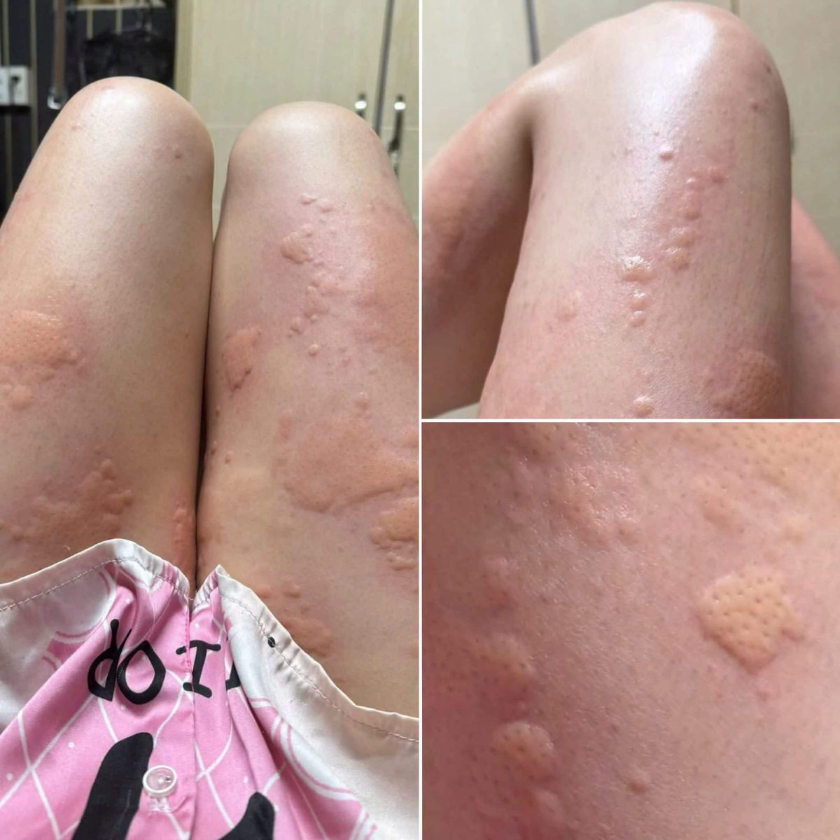 _priya9's tweet photo. Please help 😭 Last night I secretly met up with my boyfriend away from our families and stayed at my friend's house, and when I woke up this morning, my legs have these swellings like this and I can't go home, please help, what is this, why does it happen, and how does it go away??
