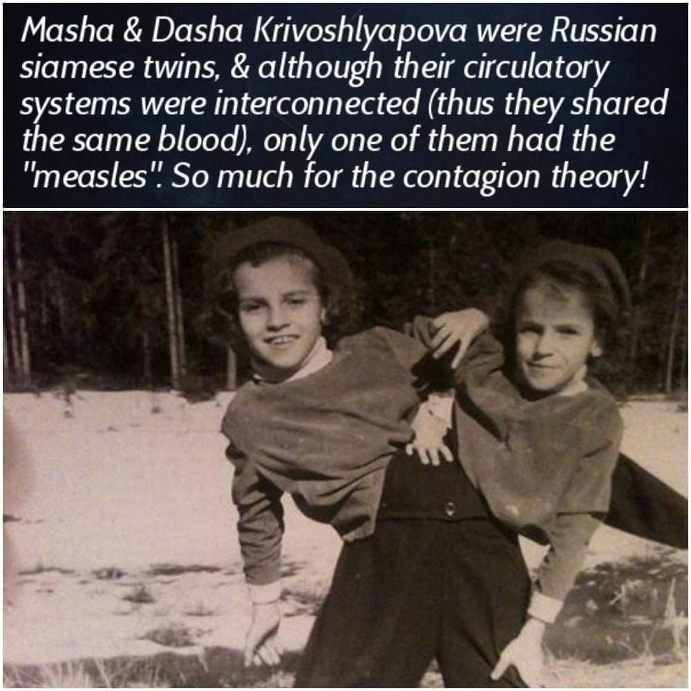 ViroLIEgy's tweet photo. Conjoined twins like Masha and Dasha shared a circulatory system yet never got sick at the same time. If germs were the decisive cause of disease, both should have fallen ill whenever one did. Their case exposes a major contradiction in the germ “theory.” https://t.co/IN0jbH4kfb