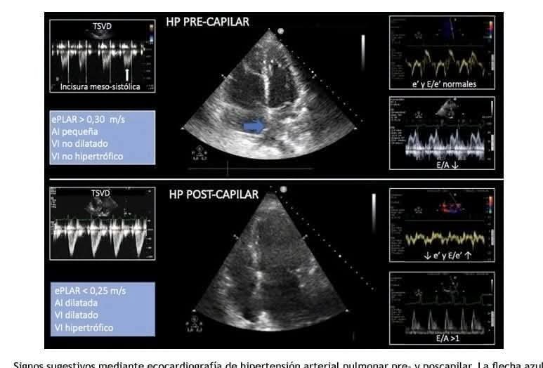 LeslieMegom's tweet photo. 👉Disfunción del ventrículo derecho🫀 en el paciente crítico. Evaluación ecocardiográfica🩸🩺
☕️Notas cafeteras 
🫀🩺Presión de la aurícula derecha . La PAD se calcula mediante la PVC y su estimación se puede realizar mediante los siguientes parámetros: • Índice de colapso de la vena cava inferior (VCI). 
1️⃣Se mide la VCI en el plano subcostal a 1-2cm de su unión con la AD, detrás de la vena hepática, en decúbito supino y al f inal delaespiración. El IC=[Dmax VCI- Dmin VCI]/Dmax VCI). 
2️⃣En el paciente crítico hay situaciones donde la dilatación de la VCI sin colapso respiratorio no predice respuesta al aporte de cristaloides
3️⃣Cociente E/e’ tricuspídeo. Mediante PW se registra la velocidad protodiastólica de llenado a nivel de la válvula tricúspide (onda E) y por DTI se registra la velocidad de relajación de la pared lateral del anillo tricuspídeo en protodiástole (onda e’). Un cociente E/e’>6 demostró asociarse a una PAD elevada:>10mmHg.
4️⃣ Validado en pacientes ventilados. 
• Patrón de flujo de las venas hepáticas: Una relación de ondas S<D se asocia con PAD elevada. 5️⃣Septo interauricular. Un desplazamiento hacia la AI se asocia con PAD elevadas.
👇🏽👇🏽👇🏽👇🏽
https://t.co/Qz83wjERm3
🗝🔓
https://t.co/CIXKVGCHNB