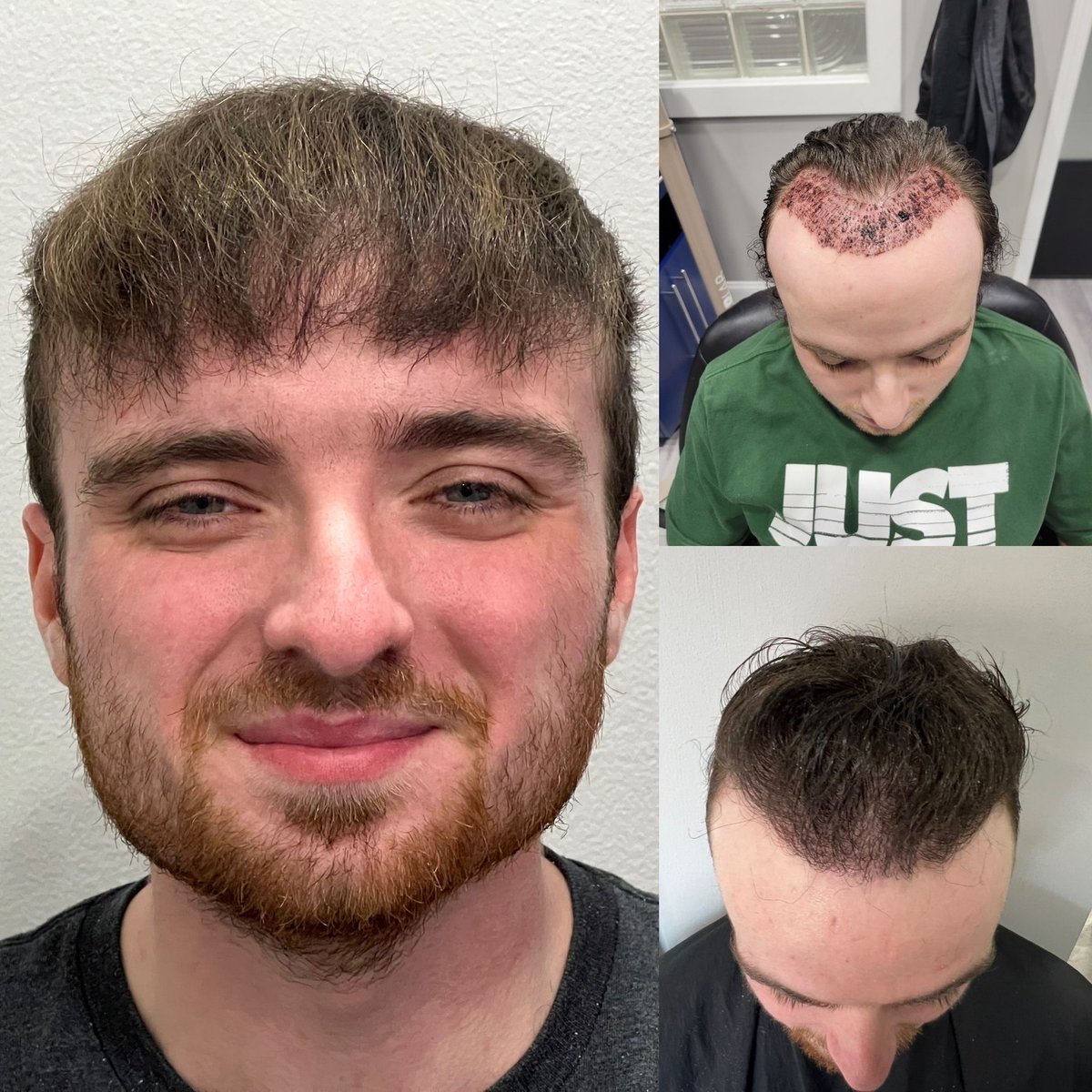 ManeImage's tweet photo. Getting a hair restoration procedure gives you back the hair you desire.  

Trust Mane Image Hair to provide you not only the latest techniques, but the most skilled surgeon and a thorough aftercare protocol.  

https://t.co/pIhvvKDLcA

#fue #fut #experts #localcare #40years https://t.co/Oy1umT7tWU