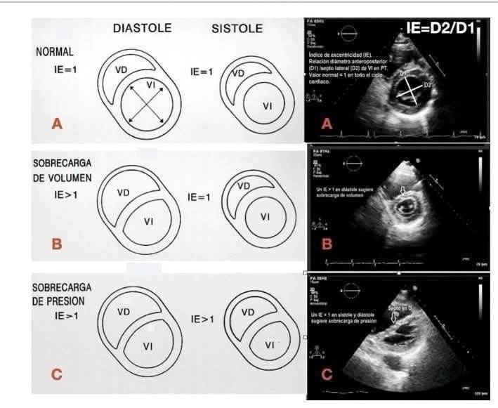 LeslieMegom's tweet photo. 👉Disfunción del ventrículo derecho🫀 en el paciente crítico. Evaluación ecocardiográfica🩸🩺
☕️Notas cafeteras 
🫀🩺Presión de la aurícula derecha . La PAD se calcula mediante la PVC y su estimación se puede realizar mediante los siguientes parámetros: • Índice de colapso de la vena cava inferior (VCI). 
1️⃣Se mide la VCI en el plano subcostal a 1-2cm de su unión con la AD, detrás de la vena hepática, en decúbito supino y al f inal delaespiración. El IC=[Dmax VCI- Dmin VCI]/Dmax VCI). 
2️⃣En el paciente crítico hay situaciones donde la dilatación de la VCI sin colapso respiratorio no predice respuesta al aporte de cristaloides
3️⃣Cociente E/e’ tricuspídeo. Mediante PW se registra la velocidad protodiastólica de llenado a nivel de la válvula tricúspide (onda E) y por DTI se registra la velocidad de relajación de la pared lateral del anillo tricuspídeo en protodiástole (onda e’). Un cociente E/e’>6 demostró asociarse a una PAD elevada:>10mmHg.
4️⃣ Validado en pacientes ventilados. 
• Patrón de flujo de las venas hepáticas: Una relación de ondas S<D se asocia con PAD elevada. 5️⃣Septo interauricular. Un desplazamiento hacia la AI se asocia con PAD elevadas.
👇🏽👇🏽👇🏽👇🏽
https://t.co/Qz83wjERm3
🗝🔓
https://t.co/CIXKVGCHNB