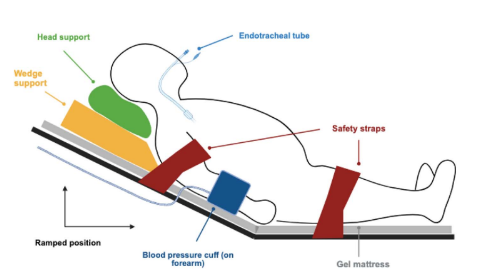 wfsaorg's tweet photo. 🚨New ATOTW581: Paediatric Obesity: Implications for Anaesthesia. 
👉 Read it here: https://t.co/0ZCcVqfLR4

This tutorial addresses the anaesthetic implications of the rising rates of childhood obesity. It lays the foundation for appropriate paediatric anaesthesia practice, covering in detail the perioperative pathway – from pre-operative assessment through to post-anaesthetic care unit discharge.