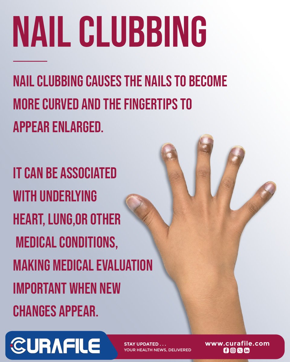 curafile's tweet photo. Nail clubbing causes the nails to become more curved and the fingertips enlarged. It may be linked to underlying heart or lung conditions, so new changes should be medically evaluated. 🩺

https://t.co/eU3MPG0AWq

#curafile #NailClubbing #NailHealth #HealthAwareness https://t.co/RIzVGTkXUs