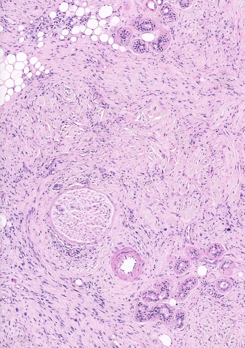 JMGardnerMD's tweet photo. Face of elderly sun damaged patient. Diagnosis from one pic?
Answer ✅ https://t.co/36ch1snH2l 
Digital slide &amp; info: https://t.co/DgX2fBvKTU 
#BSTpath #pathology #pathologists #pathTwitter #dermpath #dermatology #dermatologia #dermtwitter https://t.co/Wlnp7plDh6