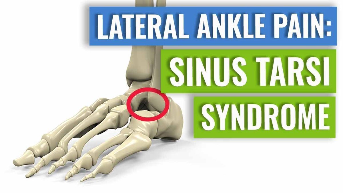 SportPhys's tweet photo. Sports physio Maryke explains what sinus tarsi syndrome is, how it is caused, and what treatments you might find useful.
https://t.co/d0Y9e37W6T -- #running #runchat #triathlon #injuryprevention #onlinephysio https://t.co/e6rTe4Ur3z