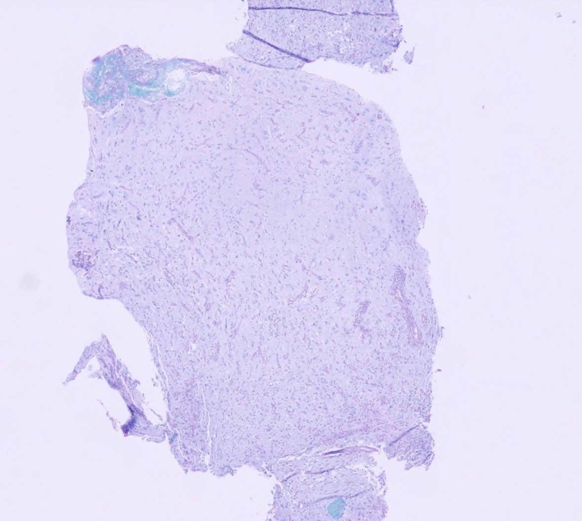 PeterKobalka's tweet photo. Strange tumefactive MS case 80 F! And the first LFB stain is weird, almost ADEM-like pattern. This case illustrates the importance of sometimes repeating stain(s) on additional blocks.
#Neuropath #Neuropathology #CNSpathology #Pathology #Pathtwitter #PathX https://t.co/QYUEfumAOh