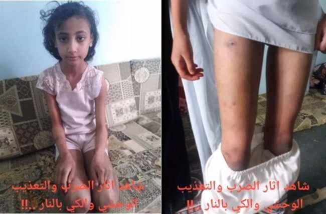 19reil's tweet photo. جريمة مروعة تهز صنعاءتعرض 4 أطفال أيتام للتعذيب والكي بالنار طوال شهرين على يد عمّيهما في منطقة قاع القيضي، مع تناوبهما على اغتصاب ابنتهم الكبرى 15 عاماً.​تدخل الجيران بعد سماع الصراخ وتم القبض على أحد الجناة بينما فر الآخروحتى الآن لم ينشر اي حكم صدر بحقهم #نساء_اليمن_أحرار https://t.co/szOdGxna1W