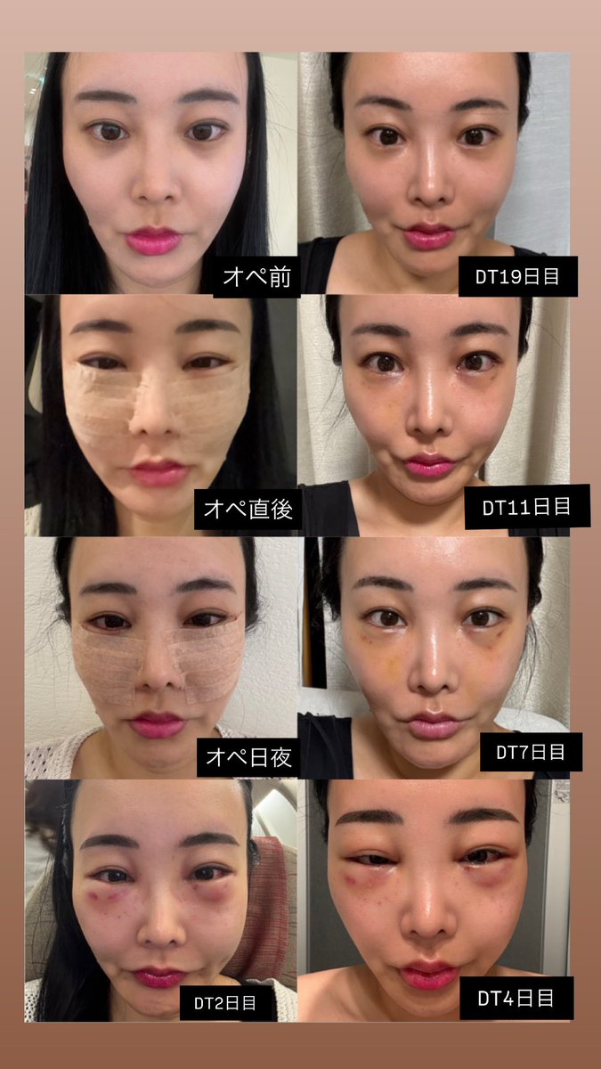 【中顔面リフト+目の下の脂肪再配置から19日目🗓】
痛み:☆☆☆☆★
硬さ:☆☆☆★★
腫れ:☆☆☆★★
麻痺:☆☆★★★
光の加減が違えど変化が一目瞭然すぎてまじでオペしてよかった。アンチエイジング。
両顎+輪郭3点にて立体感が無くなってた私の顔に立体感が戻ってきた😭😭😭 嬉しい😭😭😭
なにより目の下の脂肪再配置にて目がぱっちり👀
痛みはほぼない。でも笑ったりするとまだまだ頬周りに拘縮が出ているのでピキっとする。あの独特な痛み。硬さは30%残ってる感じがする。
腫れはほぼ引いている感覚だが、まだまだ自分の感覚としては腫れている感じがするのでまだまだスッキリしそう🥹✨️✨️
右頬のみ強い麻痺がまだ残っており、ピリピリしてきていて戻ってきている感覚はある。高周波ケアを頑張る。私の神経早く戻ってきてえええ!!!
動画で見るととても変化が分かりやすいので是非見てください❣️まだまだ目を細めるとリフト独特の腫れが🥶 根気強くケアを頑張ります‼️
どこのクリニックでお世話になったのか質問DM来るのでタグ付けします🏷️
🏥:@re_wind_jp