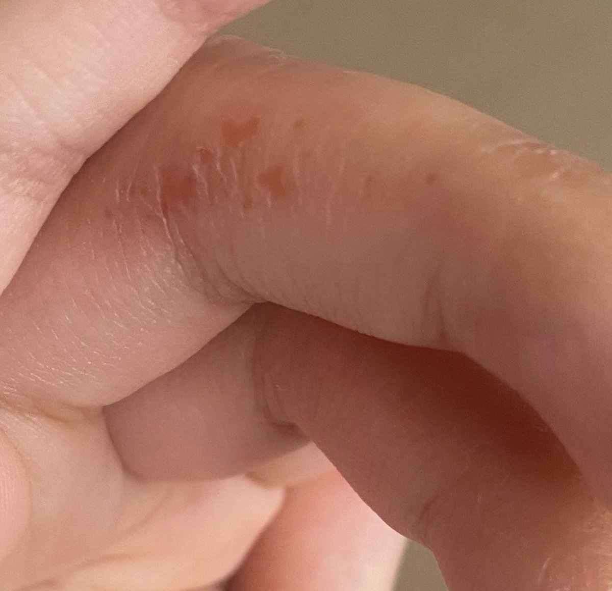 solartsun's tweet photo. Que alergia del demonio si antes no (notaba que) estaba estresada ahora sí, fuerzas a mi gente con dishidrosis y enfermedades hincha pelotas en general https://t.co/K2GlHeTe8M