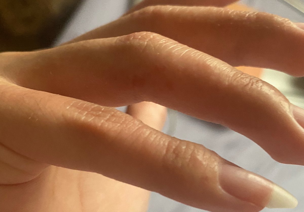 solartsun's tweet photo. Que alergia del demonio si antes no (notaba que) estaba estresada ahora sí, fuerzas a mi gente con dishidrosis y enfermedades hincha pelotas en general https://t.co/K2GlHeTe8M