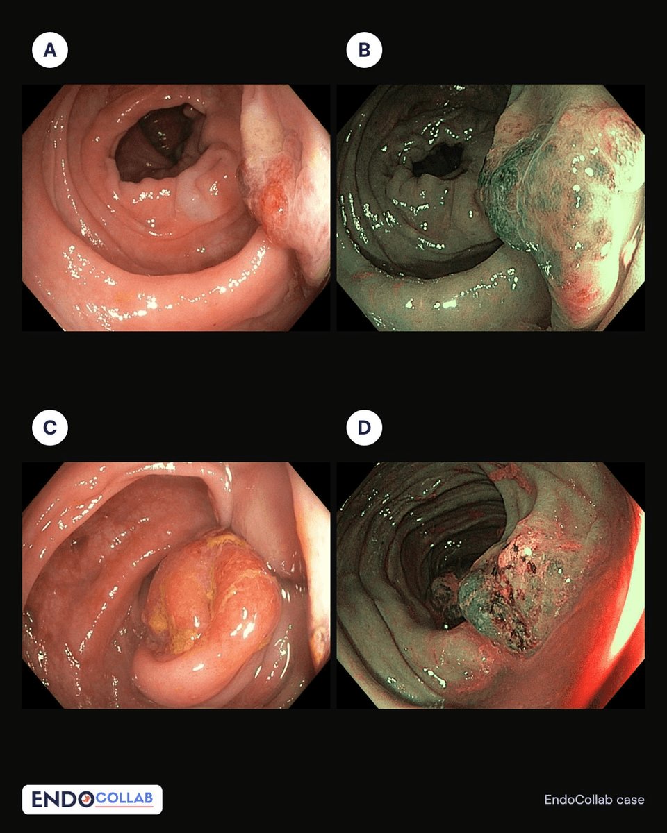 EndoCollabcom's tweet photo. Quiz: 56M, CT read as a stenosing left colon.
 
First colonoscopy stopped mid-sigmoid on poor prep; distal biopsies suggested SCAD or ischemic colitis.
 
Repeat with adequate prep: A-D.
 
Diagnosis? https://t.co/6uuk9nwuCo